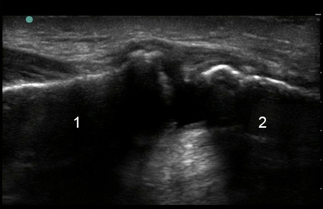 Shoulder Acromioclavicular Ac Joint Separation Image Sonosite